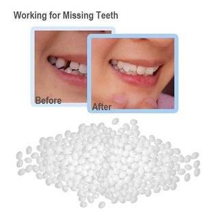 Teeth Gap Filler – Temporary Tooth Repair Kit for Missing, Chipped & Broken Teeth
