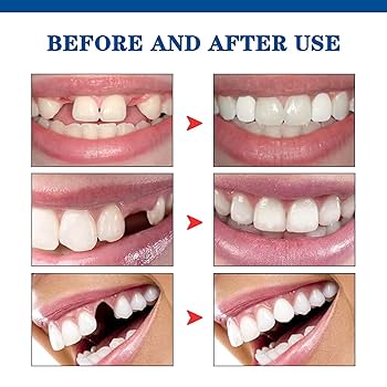 Teeth Gap Filler – Temporary Tooth Repair Kit for Missing, Chipped & Broken Teeth